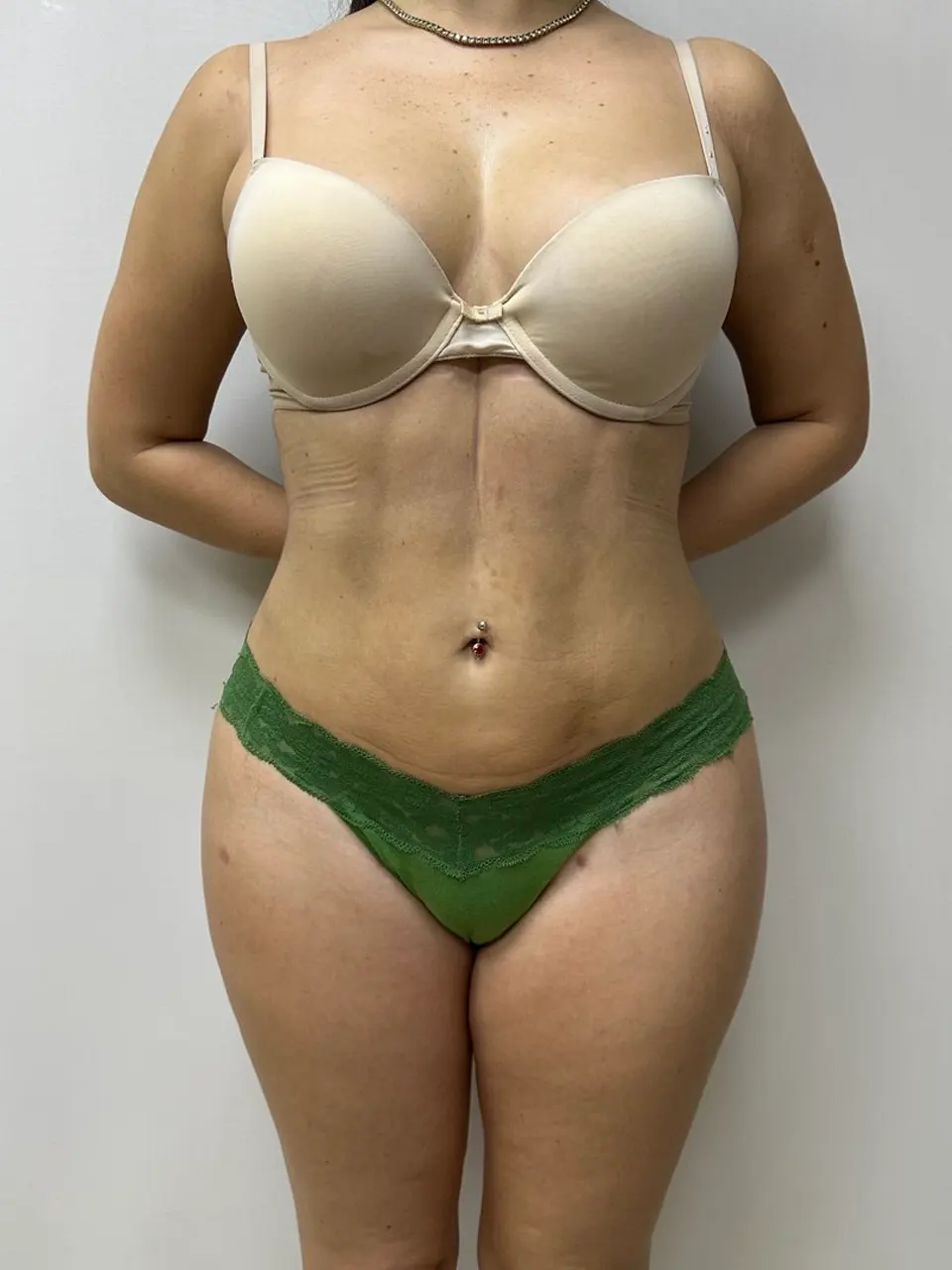  liposuction and BBI — after